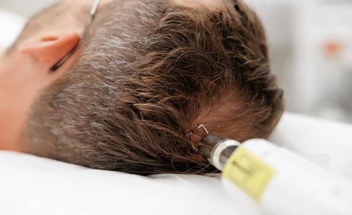 How to Choose a Hair Replacement System That Fits Your Lifestyle